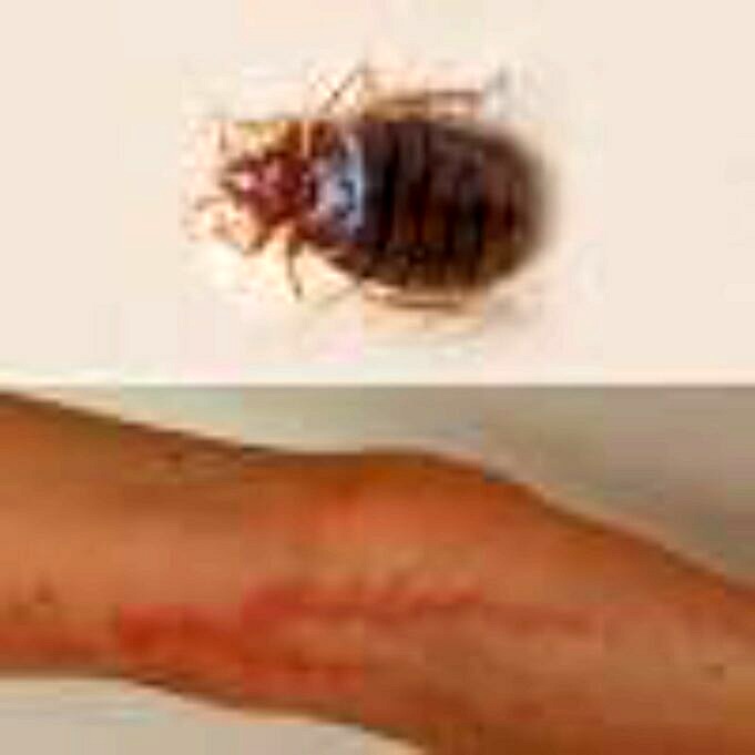 Flea Bites Vs. Bed Bug Bites. How To Tell The Difference & Why It Matters